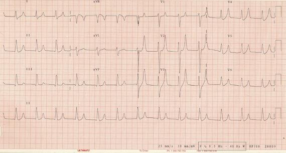 What s the T wave abnormality? 81 yo, male with palpitations.