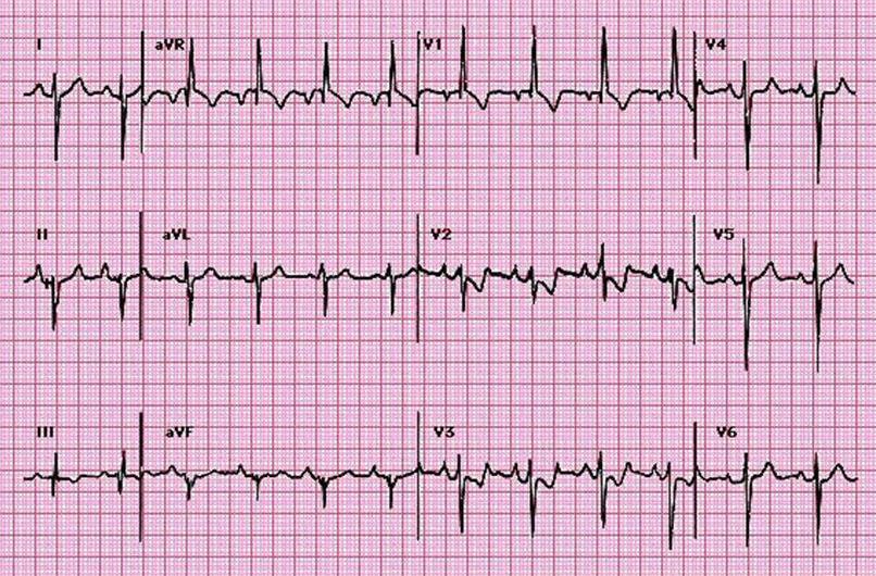39yo female. SOB. PMH- Nil DHx- COCP What are the abnormalities on this ECG? What is the diagnosis? How would you present it?