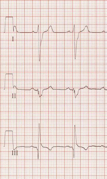 ECG changes in pulmonary embolism Classical S1Q3T3 Occurs in only 20% of PE.