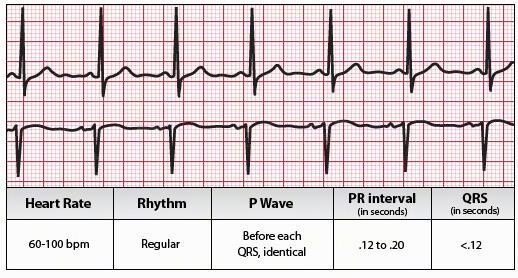 Basic ECG Interpretation Rate Rhythm Axis P Waves/PR