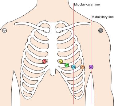 Setting up an ECG 1 V1-4 th Right intercostal space at sternal border 2 V2-4 th Left intercostal space at sternal border 3 V4-5 th Left intercostal
