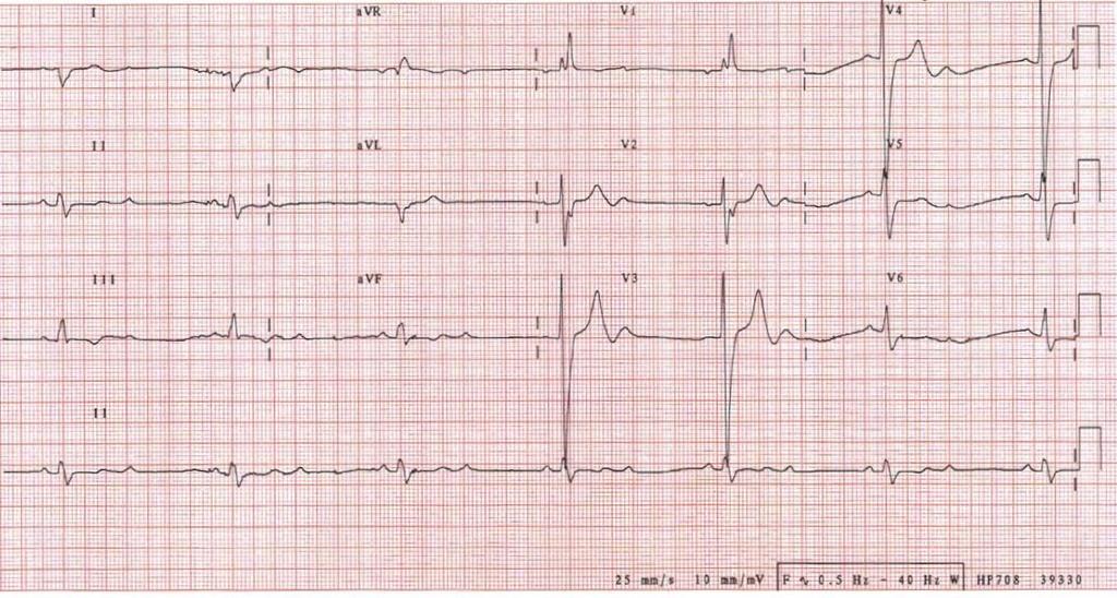 78yo in ED. Collapsed PMH- CCF DH?
