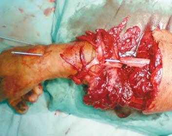 A 12-cm vein graft was harvested from the great saphenous vein in the region of the ankle and foot, was reversed and interposed between the radial artery (Figure 4).