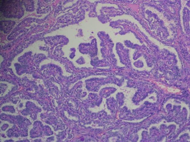 4: papillary carcinoma cytology showing intra