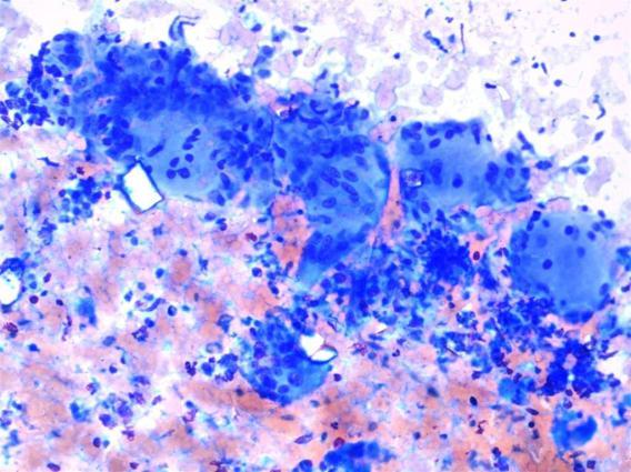 Fig.5: Papillary carcinoma thyroid histopathology showing papillae composed of tumor cells having orphan Annie eyed nuclei.(histopathology, H and E,10x) Fig.