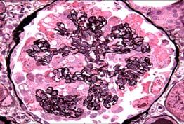 HIV-Associated Disease Slide 12 of 41 May present with either AKI or CKD HIV-associated nephropathy (HIVAN) Immune complex