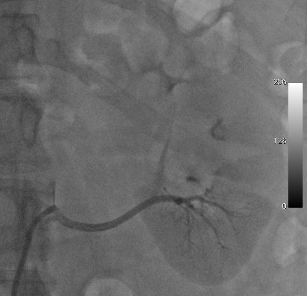 Renal Angiogram Prudently limit contrast