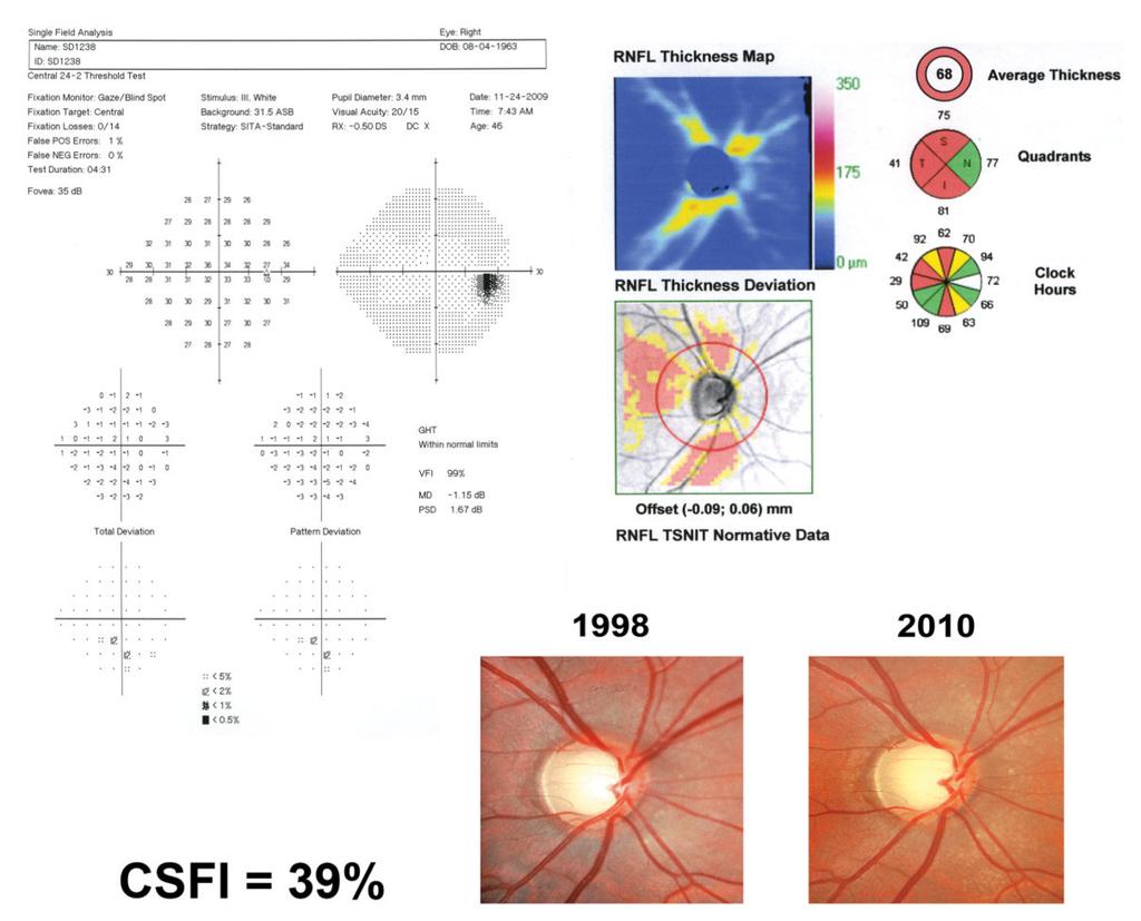 Medeiros et al. Page 18 Figure 7. Eye with preperimetric glaucoma included in the study.