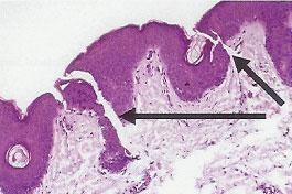 Histology of skin showing puncture sites where the needle has penetrated (arrows).
