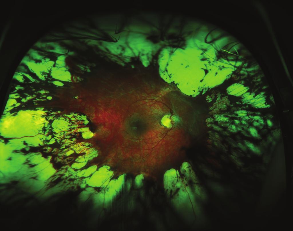 4 BioMed Research International Figure 3 A wedge-shaped area of temporal avascular retina, in close proximity to the fovea, is classically seen in APROP.