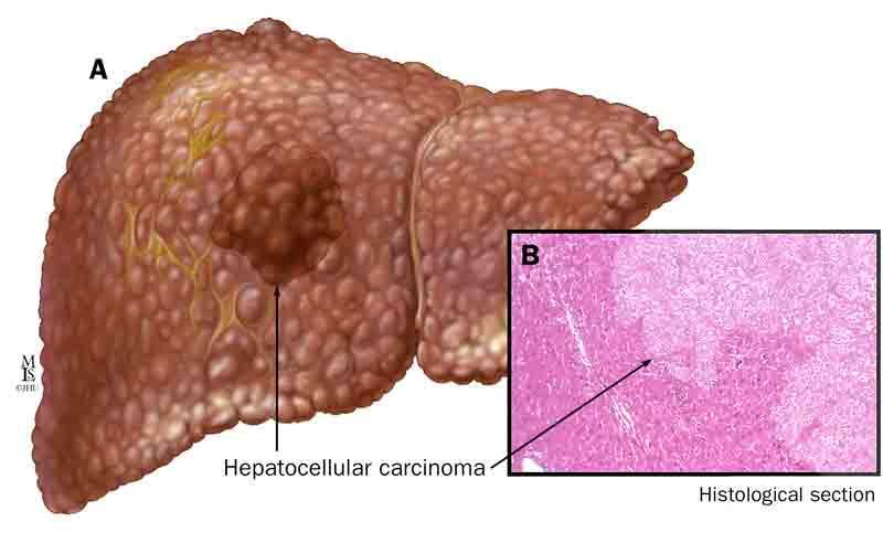 Hepatocellular Carcinoma (HCC) The most aggressive and prevalent form of primary liver cancer In men, it is the 5 th most common cancer and in women it is the 7 th worldwide Current treatments are