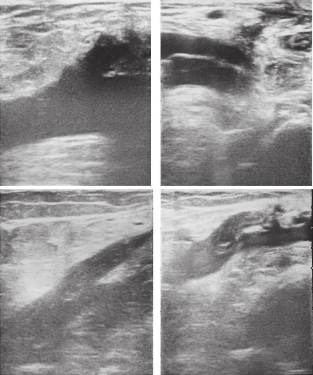 Thrombosis of the Saphenous Vein Stump Fig. 1 (A) Saphenous stump without thrombus. (B) Class 1: Saphenous stump with thrombus not extending into deep vein.