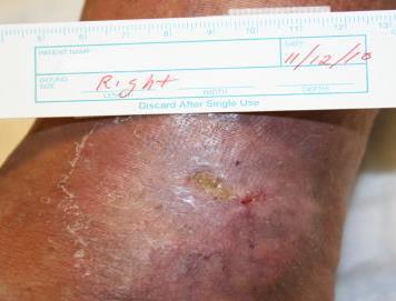 Healed Venous Ulcer Active Venous Ulcer At this severe stage, patients are
