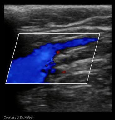 HOW TO LEARN IF YOU HAVE VEIN DISEASE? An ultrasound scan is the only definitive way to diagnose it.