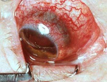 Etiology: Full-thickness wound of the eyewall caused by