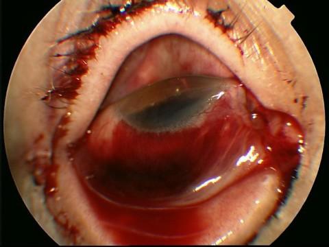 Clinical findings: Cover rupture - prolapsus of