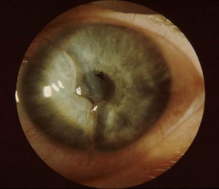 wound of conjunctiva, cornea,