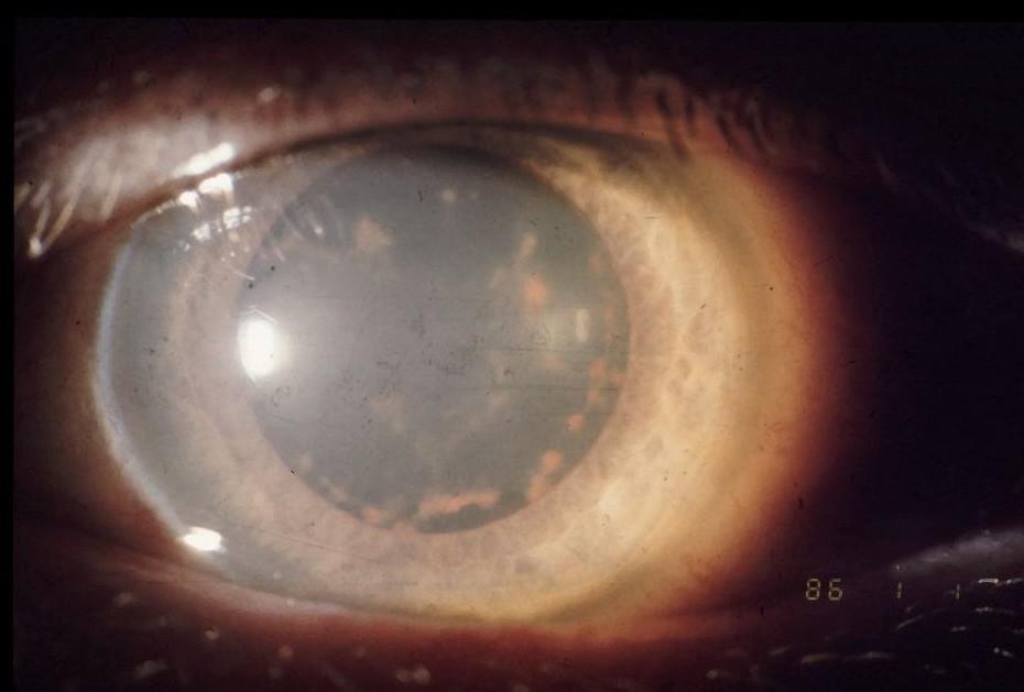 IOFB Ocular damage Siderosis Siderotic changes include the following clinical findings: Chronic open-angle glaucoma Brownish discoloration of the iris Dilated, nonreactive pupil Yellow cataract with
