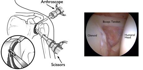 Surgical Procedure Positioning and Preparation Once in the operating room, you will be positioned so that your surgeon can easily adjust the arthroscope to have a clear view of the inside of your