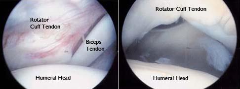 (Left) An arthroscopic view of a healthy shoulder joint. (Right) In this image of a rotator cuff tear, a large gap can be seen between the edge of the rotator cuff tendon and the humeral head.