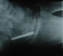 fractures Acute:- screw