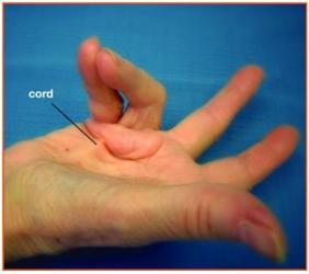 Dupuytren s Contracture Very common in United Kingdom Nordic Genes (Vikings) Requires committed patient, for