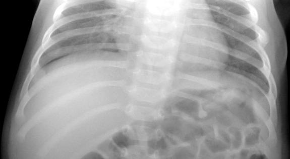 NONACCIDENTAL TRAUMA Rib fractures are common Can be difficult to see on x rays unless callus has