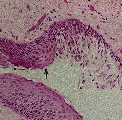 Metaplasia is the conversion of one adult differentiated cell type to another. Generally it is the result of persistent cellular trauma and serves as a protective mechanism.