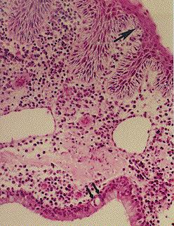 There also was invasion of the cartilaginous tissue by squamous cell carcinoma (not seen here). Metaplasia, aural polyp.
