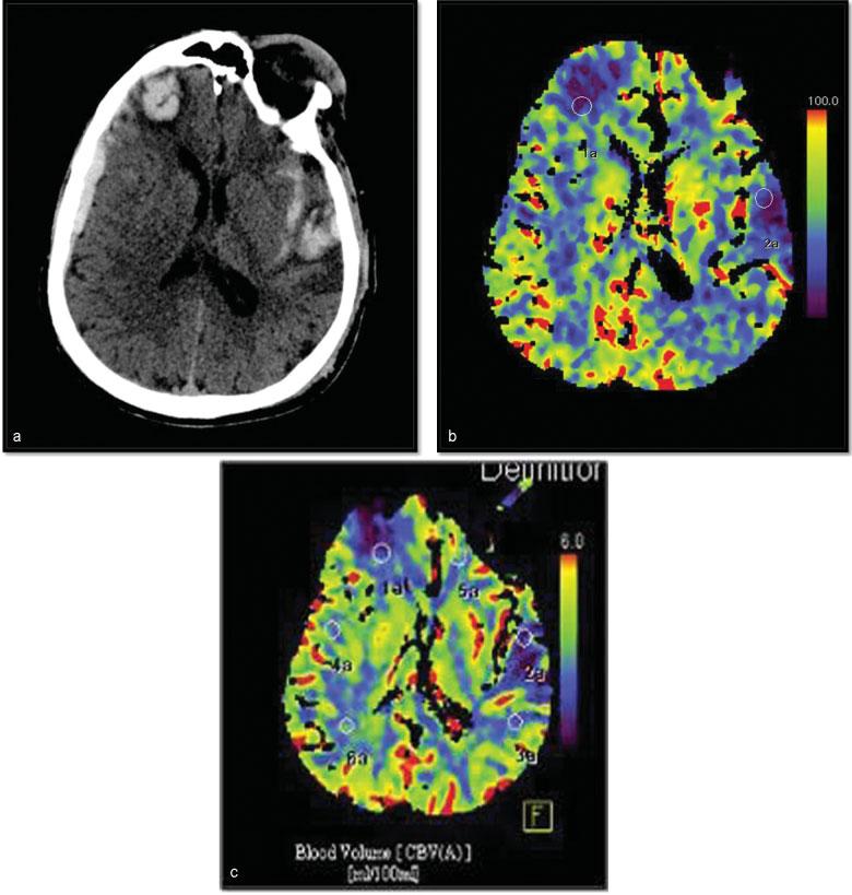 PCT Stud Velho et al. 29 Fig. 3 (a) Plain CT of the brain of a oung adult showing right frontal and left temporal contusion. The patient was admitted with GCS of 15/ 15.