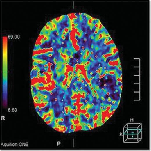 30 PCT Stud Velho et al. Fig. 4 Normal perfusion scans of the brain. Table 8 Sensitivit Sensitivit of admission perfusion CT in detecting contusions: 36/38 100 ¼ 94.