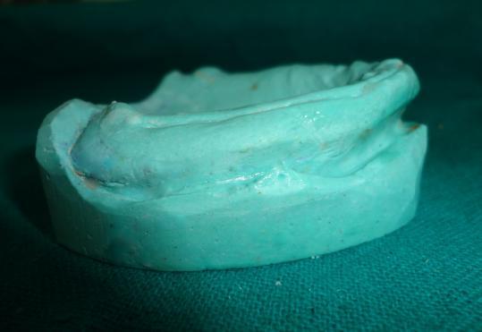 anterior labial undercut [Figure-10].