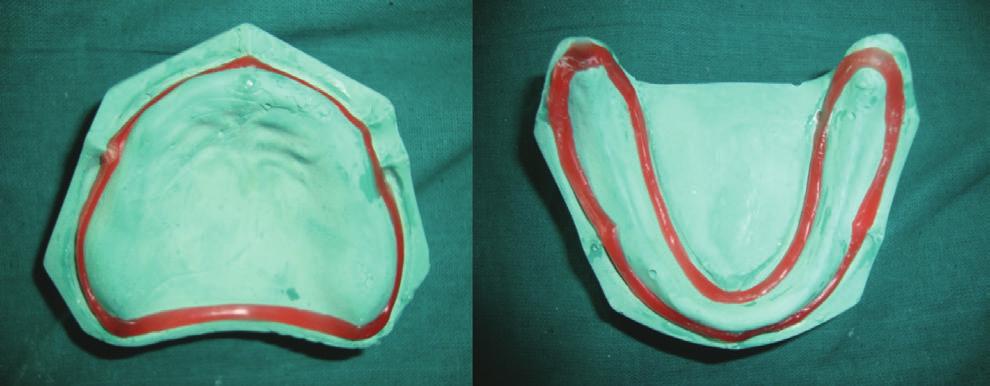 recommends the placement of wax spacer all around, except the posterior part of the palate, which according to him are at high angles to the occlusal forces [8].