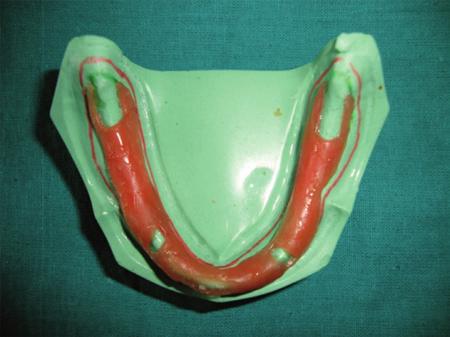 In the second technique, he describes of making an alginate primary impression. A primary cast is poured. After analysis of cast contours, undercuts are blocked out.