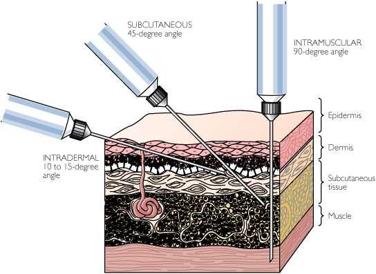 Intramuscular injections Method of injection -Thoroughly clean the skin-insertion site using alcohol swab for 30 seconds and then allowed to dry -Prepare the injection aseptically.