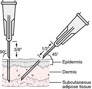 Subcutaneous injections Method of injection -Thoroughly clean the skin-insertion site using