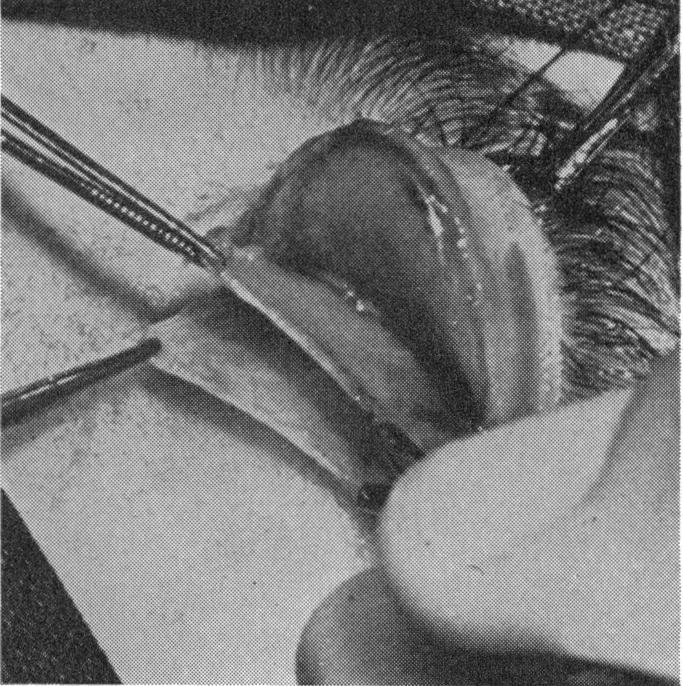elasticity. The lid margin is not distorted. The lid sulcus is created automatically without any complicated through-andthrough suturing.