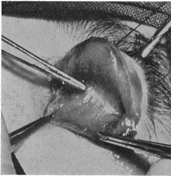The conjunctiva is incised at the upper border of the tarsal plate and peeled off from the underlying "cremaster tarsus" towards the fornix (Fig. 7).