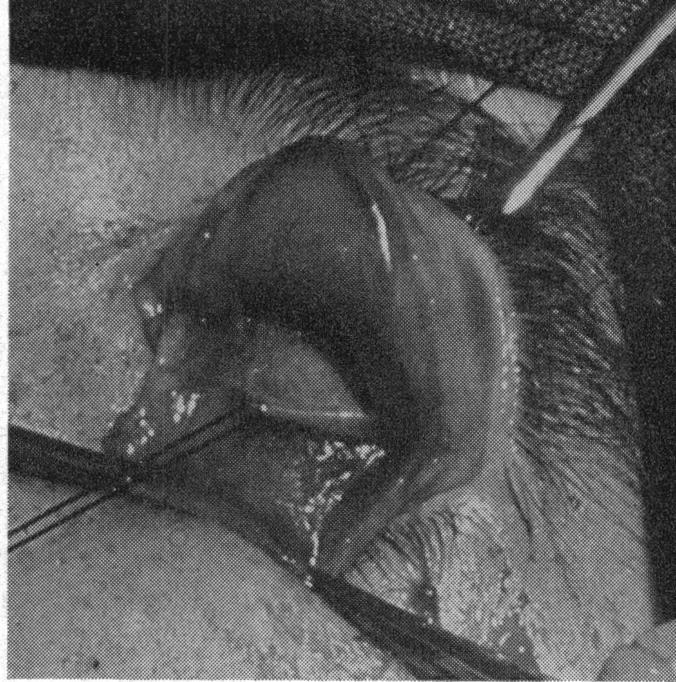 The orbital fat lies above contained in a thin envelope of connective tissue and does not prolapse if this layer is not damaged. FIG. 10.-A stitch has been placed in the FIG. 11.