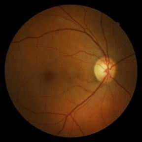 Why is Diabetic macular edema so important? The macula is responsible for central vision. Diabetic macular edema may be asymptomatic at first.