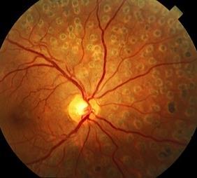 Scatter Laser or PRP (pan retinal photocoagulation) For PDR Prior to bleeding or RD Hundreds of peripheral retinal burns Risks