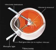 Vitrectomy Surgical Procedure For bleeding and retina detachment Risks include: Recurrent vitreous hemorrhage Severe visual