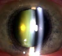 Cataracts Clouding of the natural lens Diabetics get
