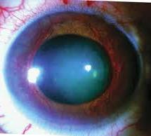 Neo-Vascular Glaucoma New blood vessels grow inside the iris causing restriction of outflow of aqueous Can be
