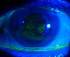 Dry Eye CORNEA - One of two clear tissues in the