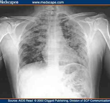 PCP Early CXR may be normal, early CT never is Host of CXR patterns including normal Most