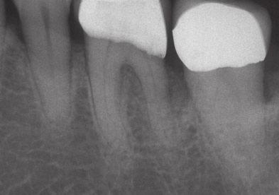 efficacious in regenerating periodontal tissue of patients with twowalled or