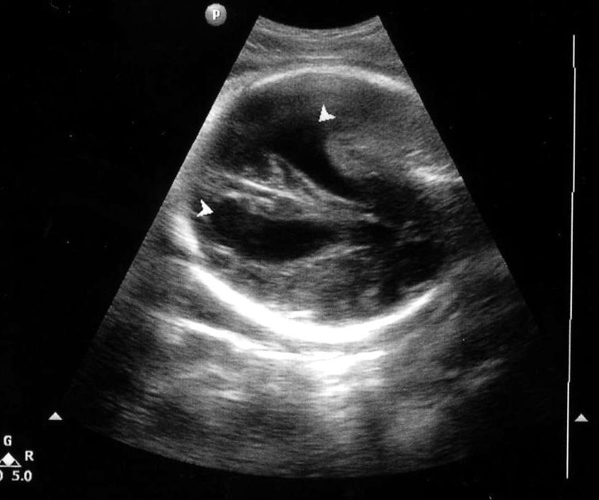 An 18 yo woman, 34 weeks pregnant on 9/13/07, is found to have an abnormal