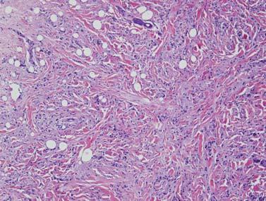 Guray, Sahin 445 Tubular adenoma (also termed pure adenoma) of the breast presents as a solitary, well-circumscribed, firm mass.