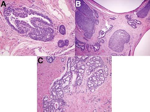 440 Benign Breast Diseases hyperplasias and their atypical counterparts atypical ductal hyperplasia and atypical lobular hyperplasia.
